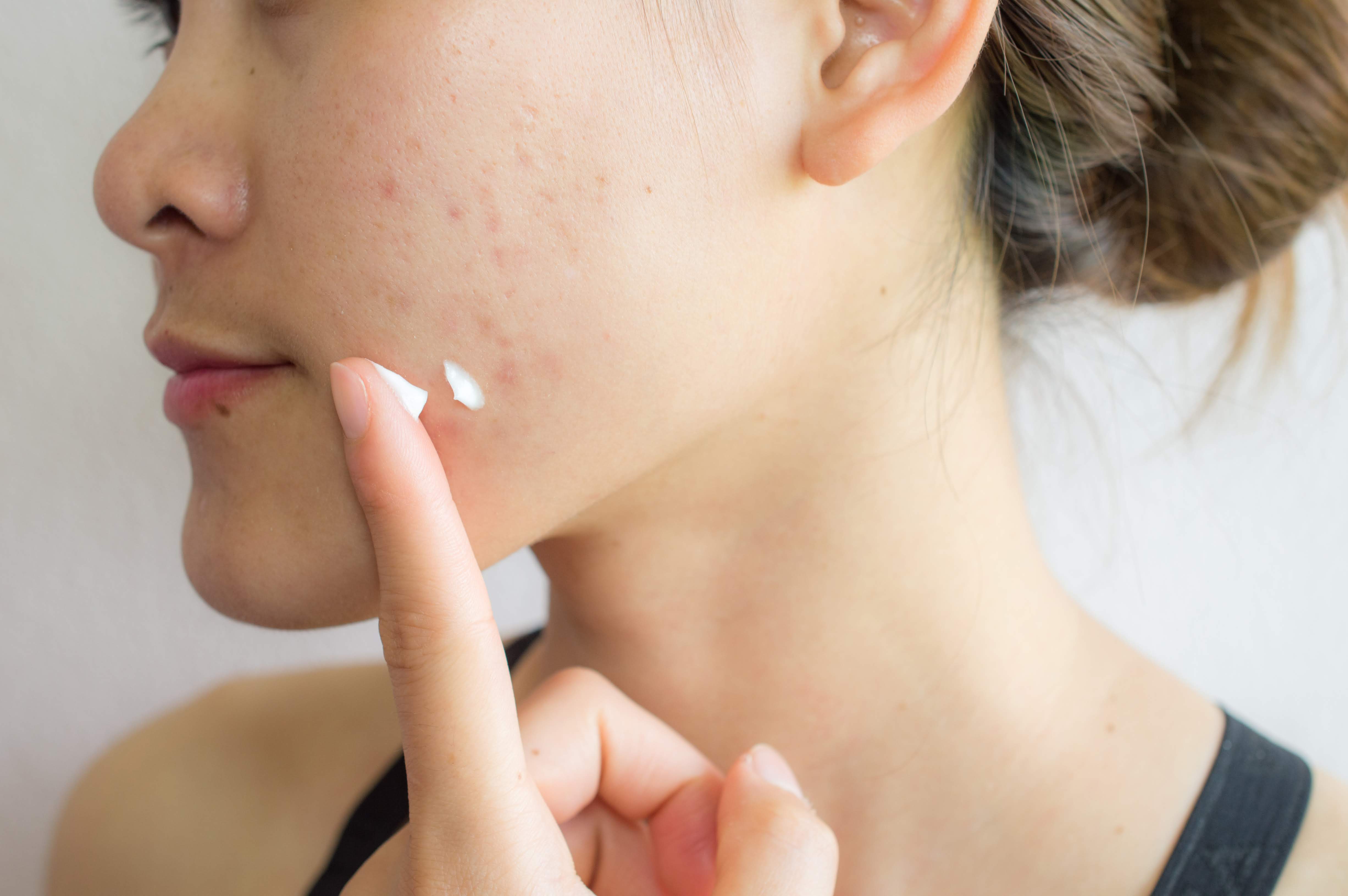 6-MONTH ACNE PROGRAMME